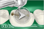 Composite Fillings Pediatric and Adult Dentistry